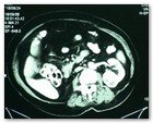 :: Pulse para Ampliar :: NEFRECTOMíA TRANSUMBILICAL: EL OMBLIGO, UNA VíA DE ACCESO QUIRúRGICO úNICA Y SEGURA PARA EXTRAER EL RIñóN