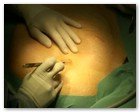 :: Pulse para Ampliar :: NEFRECTOMíA TRANSUMBILICAL: EL OMBLIGO, UNA VíA DE ACCESO QUIRúRGICO úNICA Y SEGURA PARA EXTRAER EL RIñóN