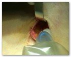 :: Pulse para Ampliar :: NEFRECTOMíA TRANSUMBILICAL: EL OMBLIGO, UNA VíA DE ACCESO QUIRúRGICO úNICA Y SEGURA PARA EXTRAER EL RIñóN