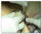 :: Pulse para Ampliar :: NEFRECTOMíA TRANSUMBILICAL: EL OMBLIGO, UNA VíA DE ACCESO QUIRúRGICO úNICA Y SEGURA PARA EXTRAER EL RIñóN