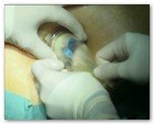 :: Pulse para Ampliar :: NEFRECTOMíA TRANSUMBILICAL: EL OMBLIGO, UNA VíA DE ACCESO QUIRúRGICO úNICA Y SEGURA PARA EXTRAER EL RIñóN
