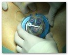 :: Pulse para Ampliar :: NEFRECTOMíA TRANSUMBILICAL: EL OMBLIGO, UNA VíA DE ACCESO QUIRúRGICO úNICA Y SEGURA PARA EXTRAER EL RIñóN