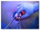 :: Pulse para Ampliar :: NEFRECTOMíA TRANSUMBILICAL: EL OMBLIGO, UNA VíA DE ACCESO QUIRúRGICO úNICA Y SEGURA PARA EXTRAER EL RIñóN
