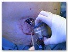 :: Pulse para Ampliar :: NEFRECTOMíA TRANSUMBILICAL: EL OMBLIGO, UNA VíA DE ACCESO QUIRúRGICO úNICA Y SEGURA PARA EXTRAER EL RIñóN