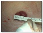:: Pulse para Ampliar :: NEFRECTOMíA TRANSUMBILICAL: EL OMBLIGO, UNA VíA DE ACCESO QUIRúRGICO úNICA Y SEGURA PARA EXTRAER EL RIñóN