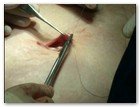 :: Pulse para Ampliar :: NEFRECTOMíA TRANSUMBILICAL: EL OMBLIGO, UNA VíA DE ACCESO QUIRúRGICO úNICA Y SEGURA PARA EXTRAER EL RIñóN