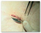 :: Pulse para Ampliar :: NEFRECTOMíA TRANSUMBILICAL: EL OMBLIGO, UNA VíA DE ACCESO QUIRúRGICO úNICA Y SEGURA PARA EXTRAER EL RIñóN
