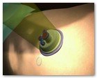 :: Pulse para Ampliar :: NEFRECTOMíA TRANSUMBILICAL: EL OMBLIGO, UNA VíA DE ACCESO QUIRúRGICO úNICA Y SEGURA PARA EXTRAER EL RIñóN