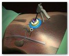 :: Pulse para Ampliar :: NEFRECTOMíA TRANSUMBILICAL: EL OMBLIGO, UNA VíA DE ACCESO QUIRúRGICO úNICA Y SEGURA PARA EXTRAER EL RIñóN