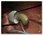:: Pulse para Ampliar :: NEFRECTOMíA TRANSUMBILICAL: EL OMBLIGO, UNA VíA DE ACCESO QUIRúRGICO úNICA Y SEGURA PARA EXTRAER EL RIñóN