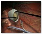 :: Pulse para Ampliar :: NEFRECTOMíA TRANSUMBILICAL: EL OMBLIGO, UNA VíA DE ACCESO QUIRúRGICO úNICA Y SEGURA PARA EXTRAER EL RIñóN