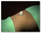 :: Pulse para Ampliar :: NEFRECTOMíA TRANSUMBILICAL: EL OMBLIGO, UNA VíA DE ACCESO QUIRúRGICO úNICA Y SEGURA PARA EXTRAER EL RIñóN