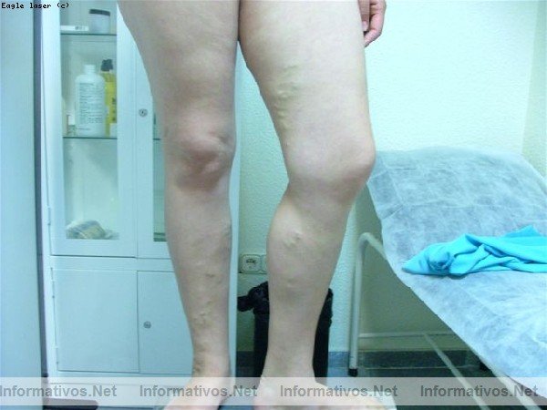 EL 40% DE LAS EMBARAZADAS PADECE VARICES EN LAS EXTREMIDADES INFERIORES