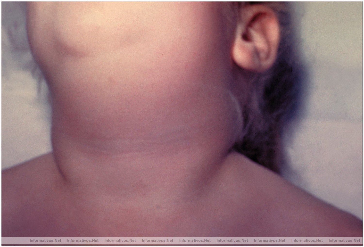 Patient with bilateral swelling in his submaxillary region due to mumps