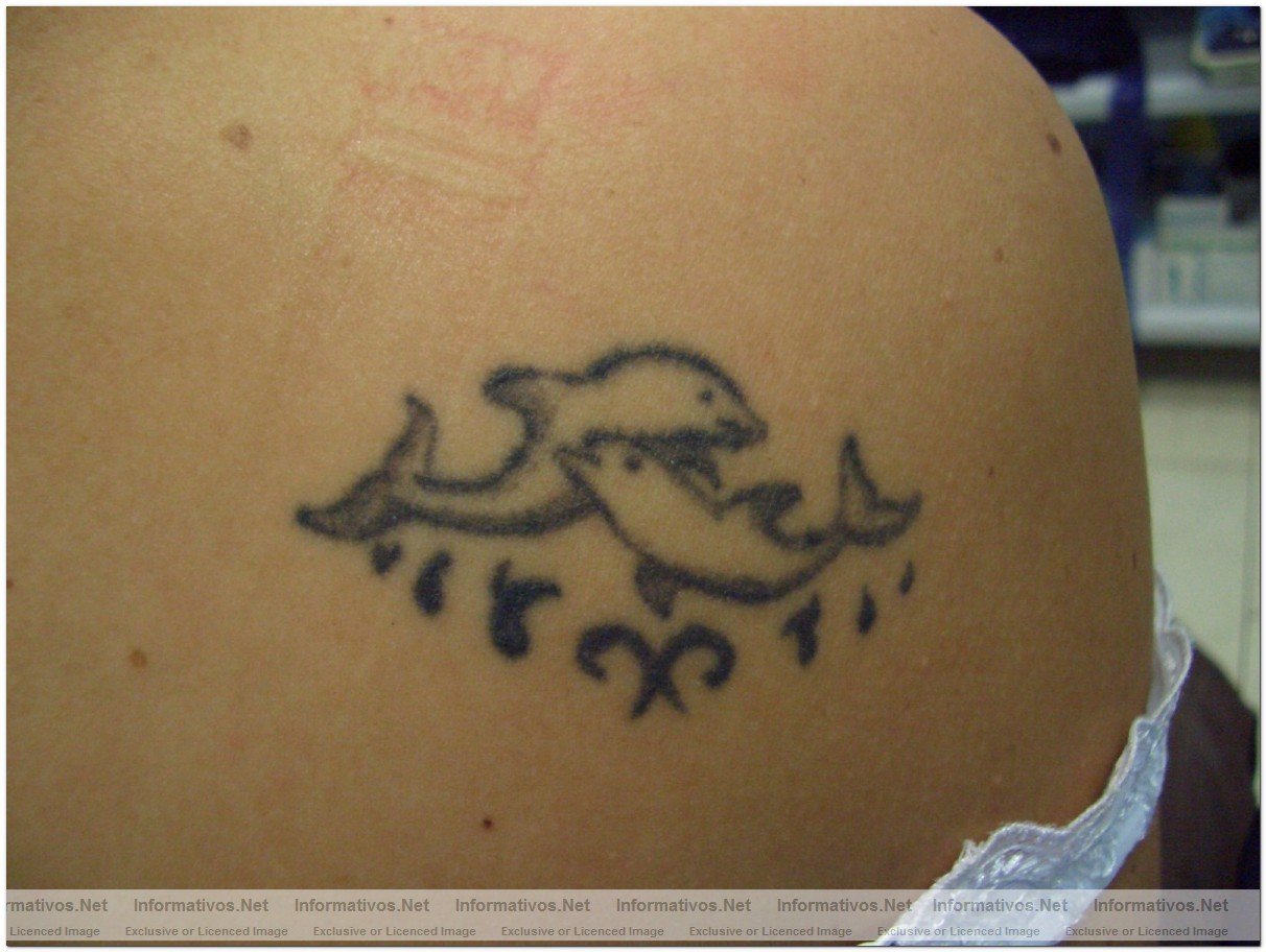 El lser permite eliminar tatuajes por sistema linftico: tatoo antes del tratamiento