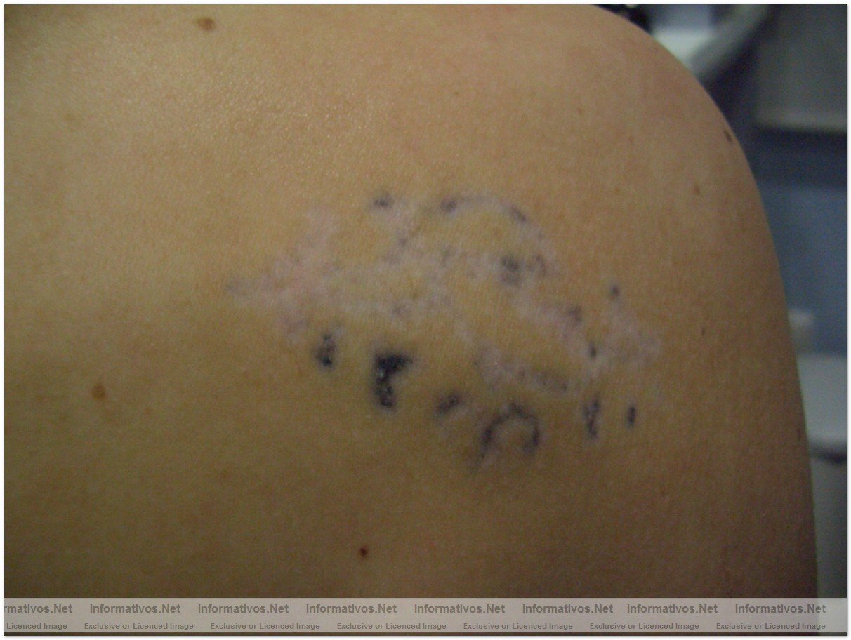 El lser permite eliminar tatuajes por sistema linftico: tatoo tras 5 sesiones