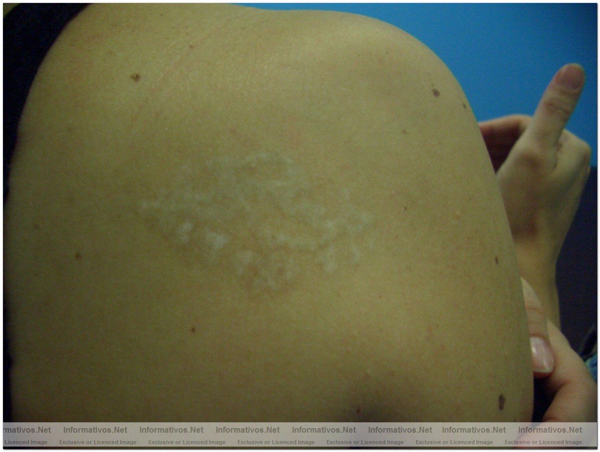 El lser permite eliminar tatuajes por sistema linftico: tatoo tras 9 sesiones