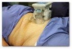 :: Pulse para Ampliar :: Centro Dermitek-SinPelo Barcelona: primer tratamiento de criolipólisis por el Dr. José Azpiazu y la Dra. Nerea Landa