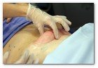 :: Pulse para Ampliar :: Centro Dermitek-SinPelo Barcelona: primer tratamiento de criolipólisis por el Dr. José Azpiazu y la Dra. Nerea Landa