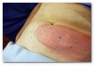 :: Pulse para Ampliar :: Centro Dermitek-SinPelo Barcelona: primer tratamiento de criolipólisis por el Dr. José Azpiazu y la Dra. Nerea Landa