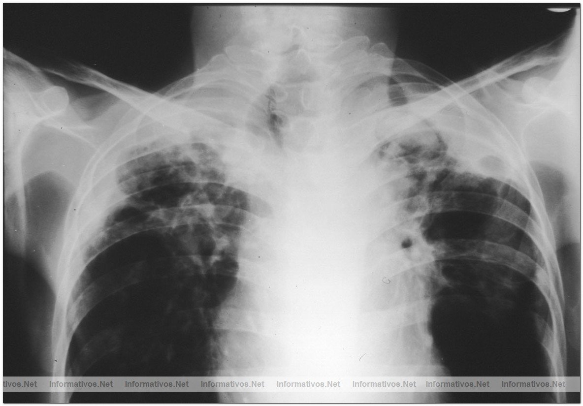 Barcelona forma parte de una investigacin mundial contra la Tuberculosis, una enfermedad que afecta por lo general a los pulmones. La tuberculosis compromete otras partes del cuerpo, como el cerebro, los riones o la columna vertebral. Si no se trata, la TB puede causar la muerte.