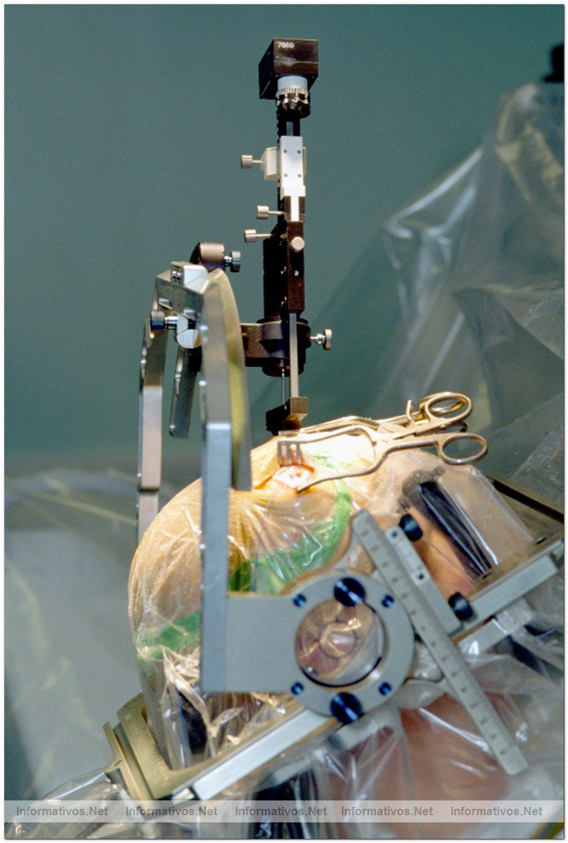 Insercin de un electrodo durante una estimulacin profunda del cerebro en un paciente de Parkinson