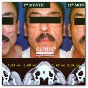 :: Pulse para Ampliar :: Lipofilling Facial: una solución no sólo a la lipodistrofia, que últimamente encuentra su ámbito de aplicación en la cirugía estética