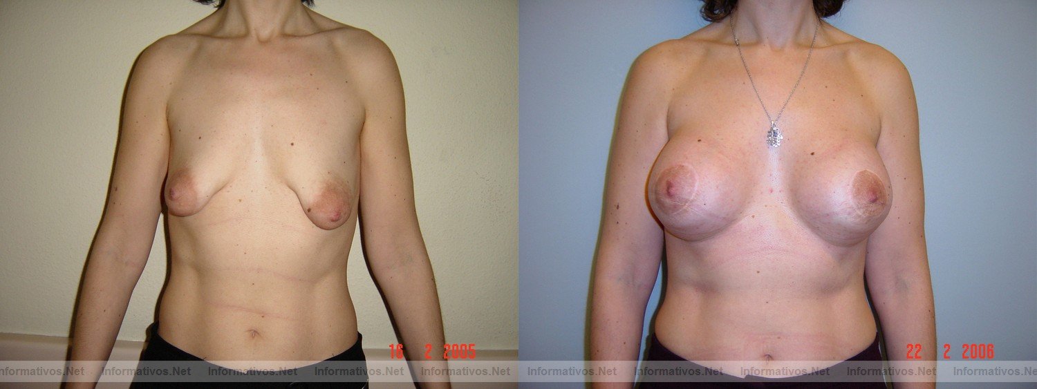 Ejemplos de operación de mamas tuberosas (antes y después) realizadas por el Dr. Oscar Junco