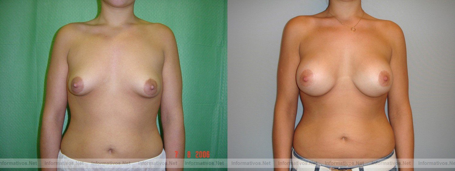 Ejemplos de operación de mamas tuberosas (antes y después) realizadas por el Dr. Oscar Junco