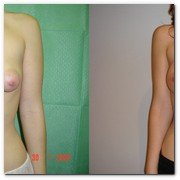 :: Pulse para Ampliar :: Ejemplos de operación de mamas tuberosas (antes y después) realizadas por el Dr. Oscar Junco