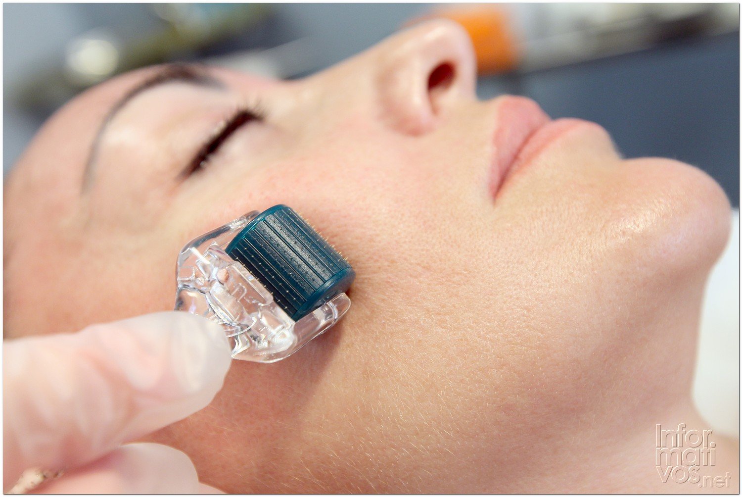 BCN24JUL012.- Tratamiento de Estimulación del colágeno facial en la consulta de la Dra. Nuria Espaulella. El Dermoroller trabajando; en este caso de 0,5 mm (uso clínico)