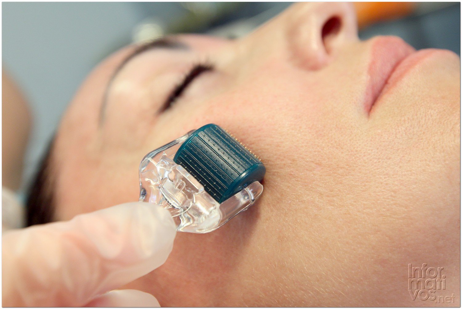 BCN24JUL012.- Tratamiento de Estimulación del colágeno facial en la consulta de la Dra. Nuria Espaulella. El Dermoroller trabajando; en este caso de 0,5 mm (uso clínico)