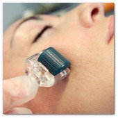 :: Pulse para Ampliar :: BCN24JUL012.- Tratamiento de Estimulación del colágeno facial en la consulta de la Dra. Nuria Espaulella. El Dermoroller trabajando; en este caso de 0,5 mm (uso clínico)