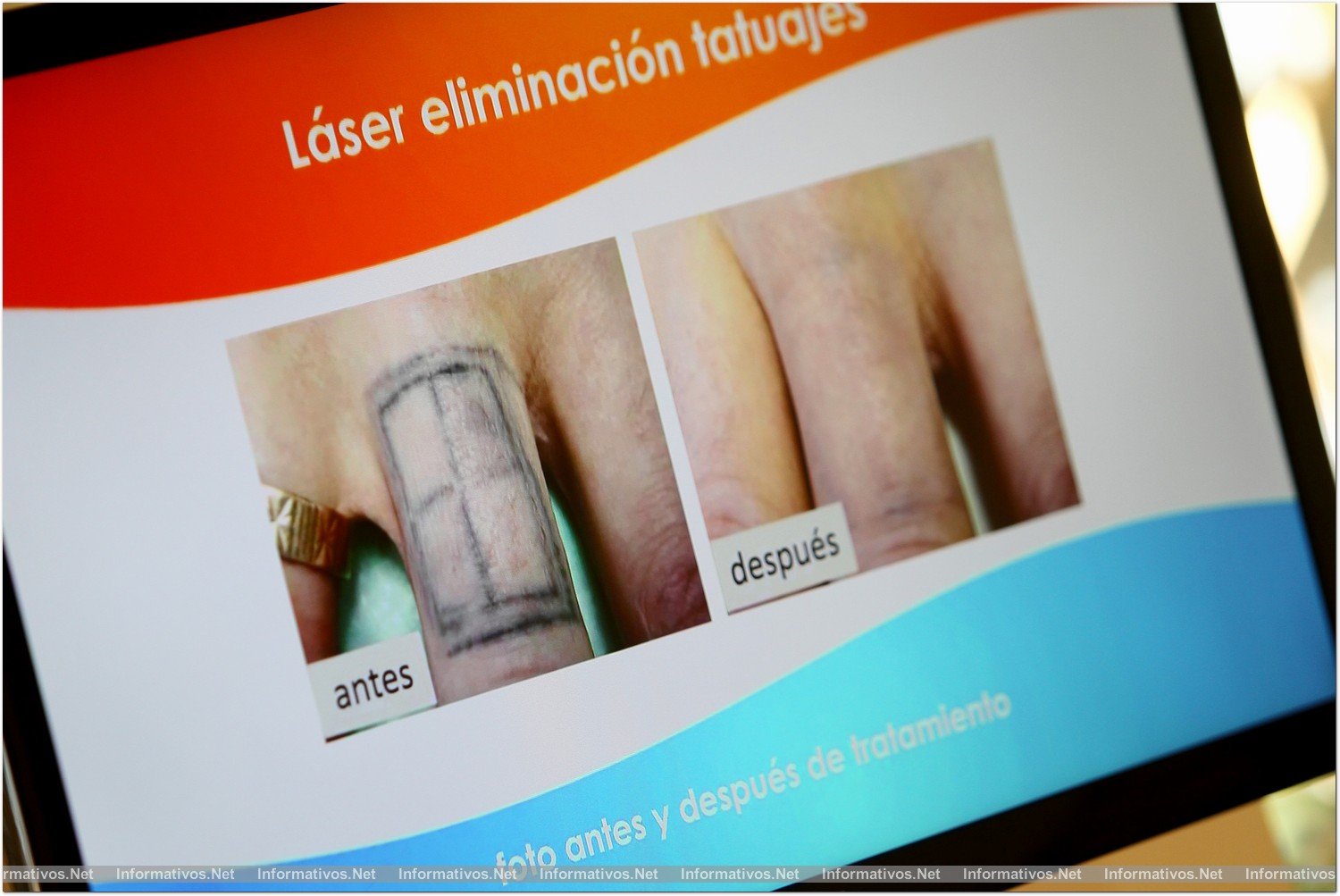 BCNJUL014.- Clínica Estética Láser Linline Barcelona. Ejemplo de eliminación de tatuaje con láser (los resultados pueden variar si el tatuaje es de colores)